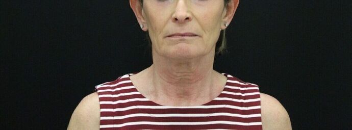 Face & Neck Lifts: Case 23 - Before