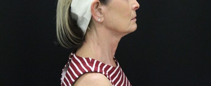 Face & Neck Lifts: Case 23 - Before