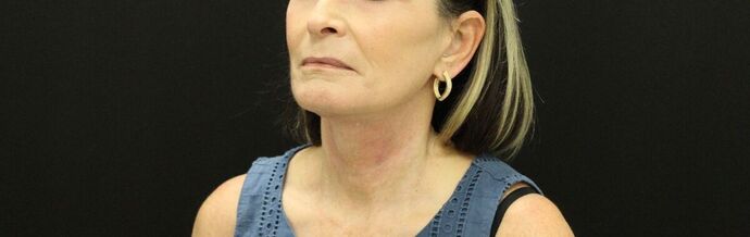 Face & Neck Lifts: Case 23 - After
