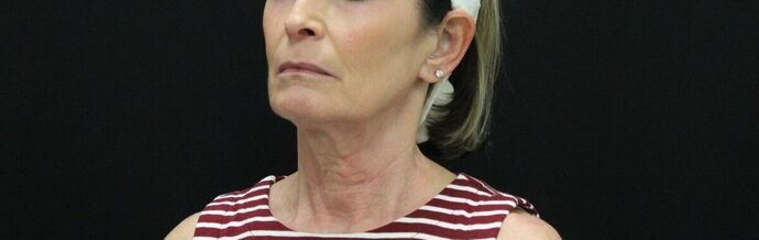 Face & Neck Lifts: Case 23 - Before
