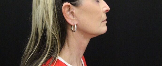 Face & Neck Lifts: Case 23 - After