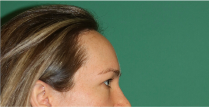 Hairline Lowering Surgery: Case 18 - Before