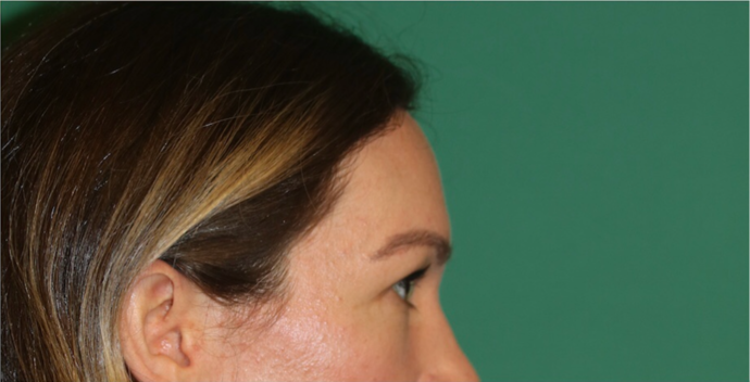 Hairline Lowering Surgery: Case 18 - After