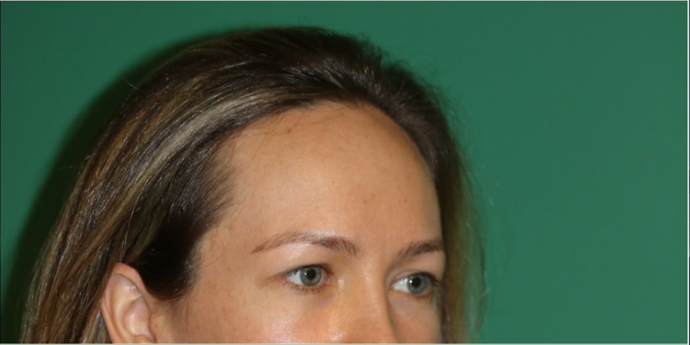 Hairline Lowering Surgery: Case 18 - Before