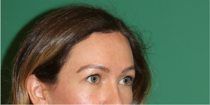 Hairline Lowering Surgery: Case 18 - After