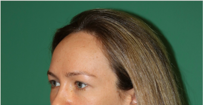 Hairline Lowering Surgery: Case 18 - Before