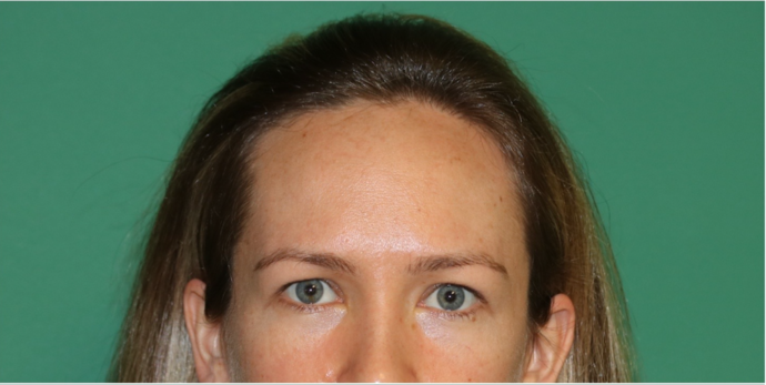 Hairline Lowering Surgery: Case 18 - Before