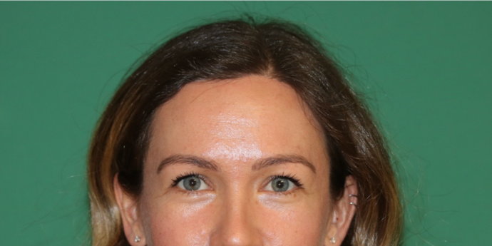 Hairline Lowering Surgery: Case 18 - After