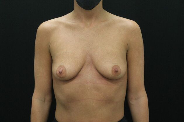 Breast Augmentation: Case 71 - Before