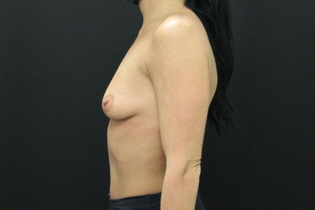 Breast Augmentation: Case 71 - After