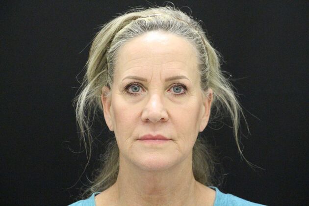 Face & Neck Lifts Case 3 - Before