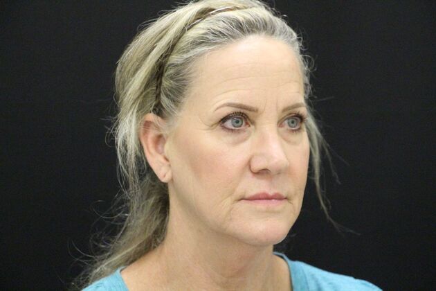 Face & Neck Lifts: Case 3 - Before