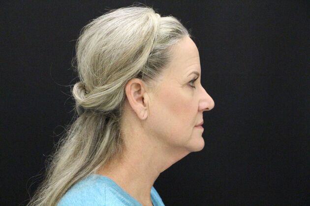 Face & Neck Lifts: Case 3 - Before