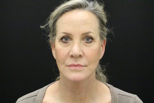 Face & Neck Lifts Case 3 - After