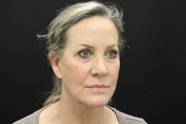 Face & Neck Lifts: Case 3 - After