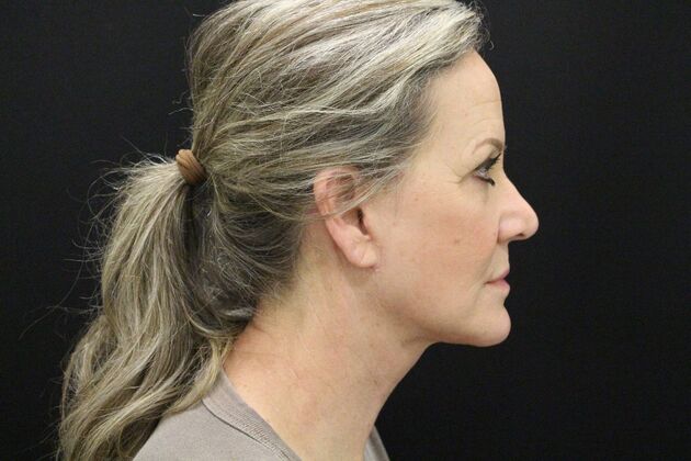 Face & Neck Lifts: Case 3 - After