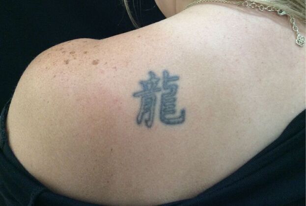Laser Tattoo Removal Case 10 - Before