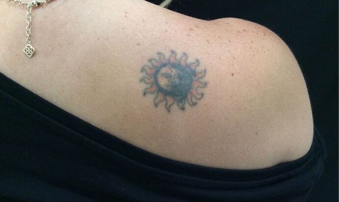 Laser Tattoo Removal: Case 10 - Before