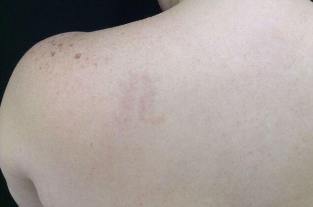 Laser Tattoo Removal Case 10 - After