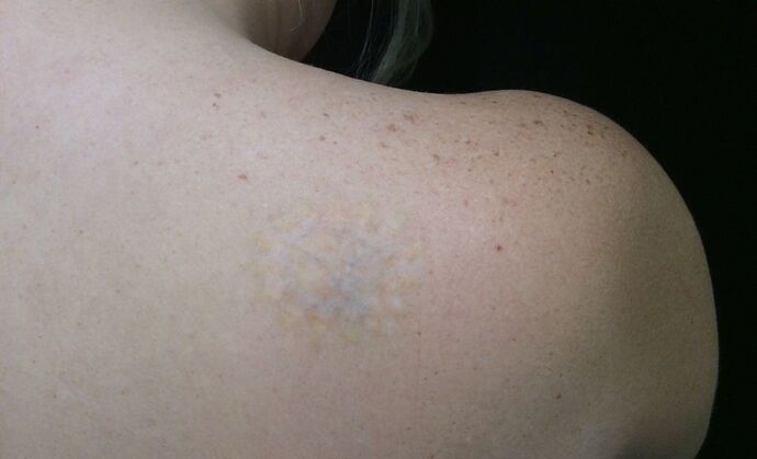 Laser Tattoo Removal: Case 10 - After