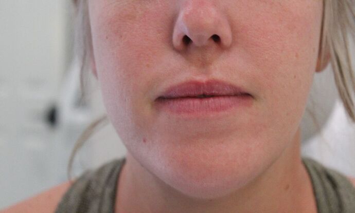 Injectables Case 1 - Before