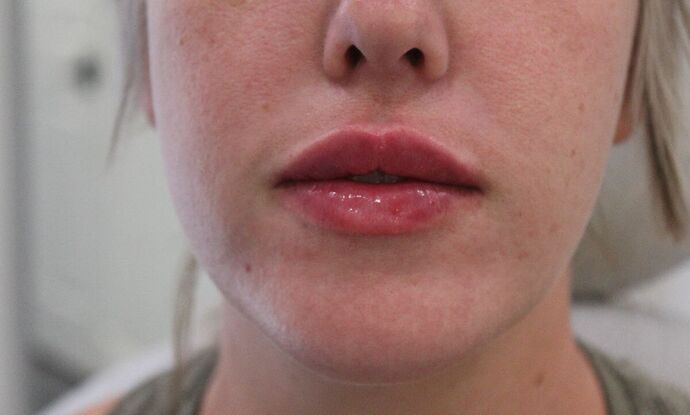 Injectables Case 1 - After