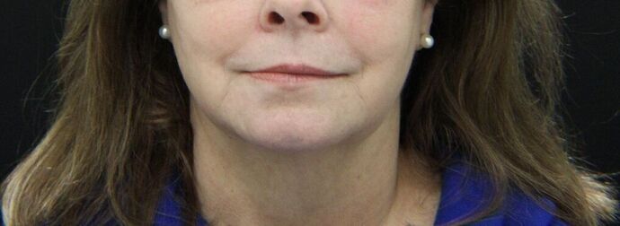 Injectables Case 2 - After