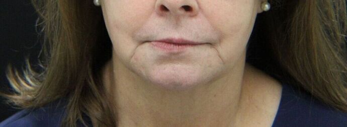 Injectables Case 2 - Before