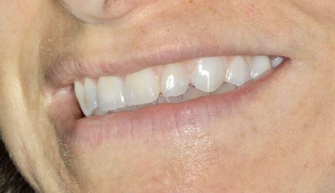 Porcelain Crowns and Veneers: Reconstruction after Tumor Resection - After