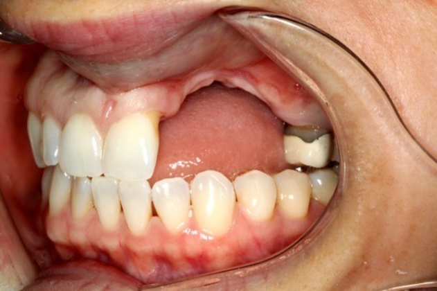 Porcelain Crowns and Veneers: Reconstruction after Tumor Resection - Before