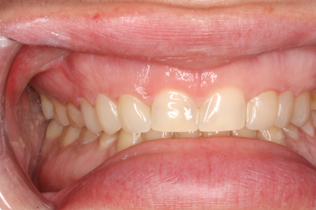 Porcelain Crowns and Veneers: Restoration of a single tooth with a crown - After