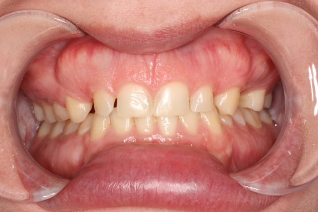 Porcelain Crowns and Veneers: Restoration of a single tooth with a crown - Before