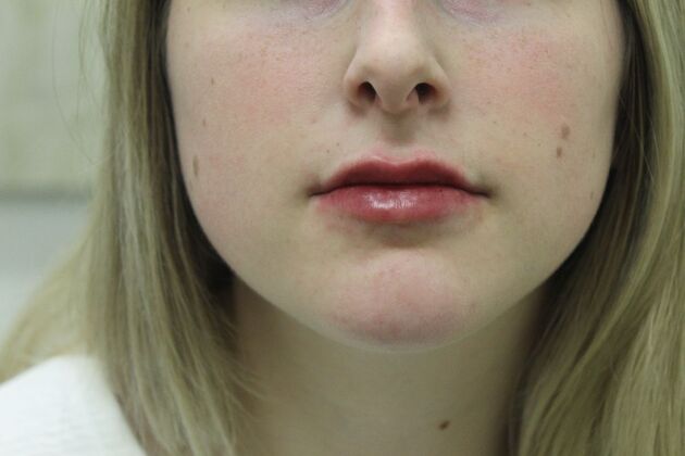Injectables Case 4 - After