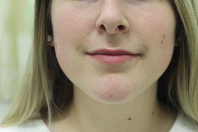 Injectables Case 4 - Before