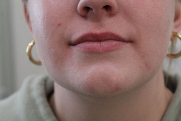 Injectables Case 5 - Before