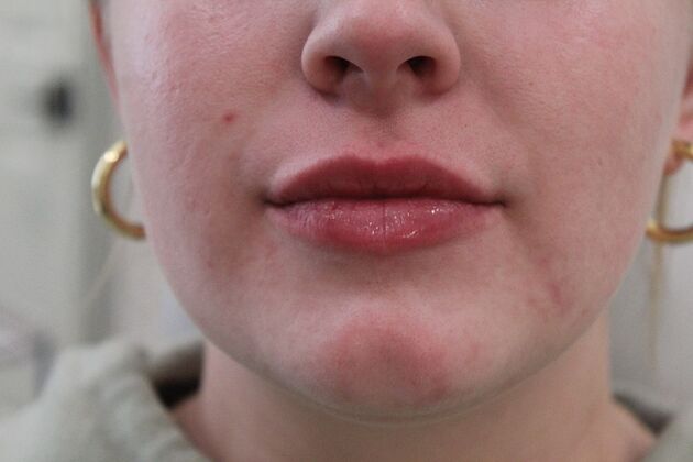 Injectables Case 5 - After