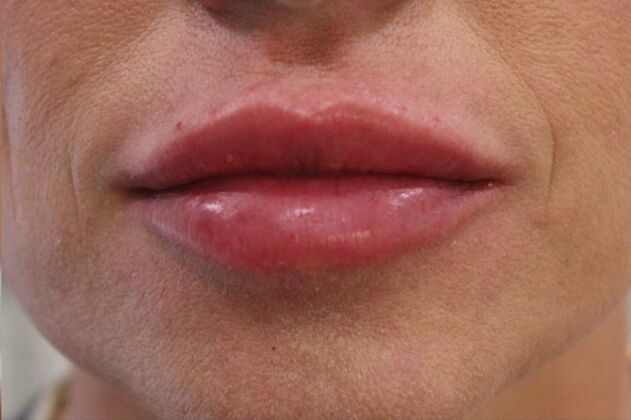 Injectables Case 6 - After