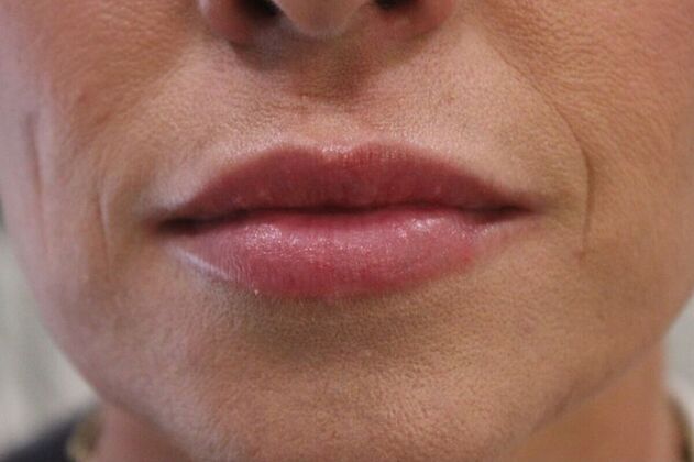 Injectables Case 6 - Before