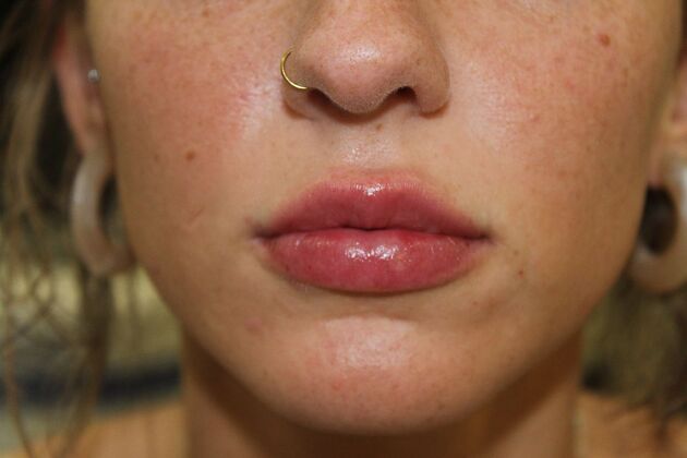 Injectables Case 7 - After