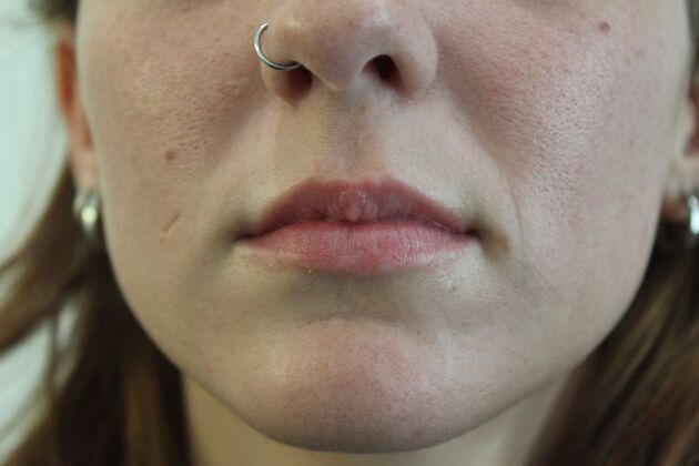 Injectables Case 7 - Before