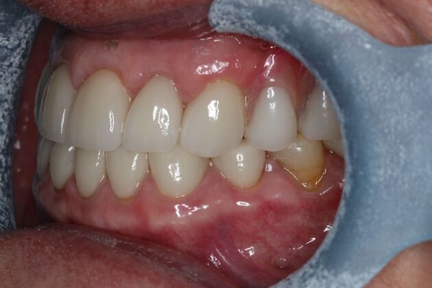 Dental Implants: Case 12 - After