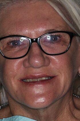 Dental Implants Case 12 - Before