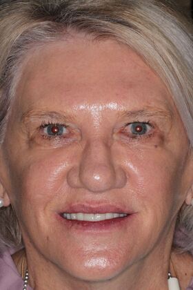 Dental Implants Case 12 - After