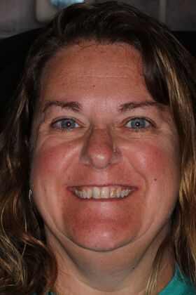 Veneers Case 30 - Before