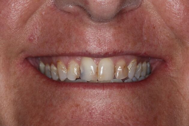 Veneers: Case 30 - Before