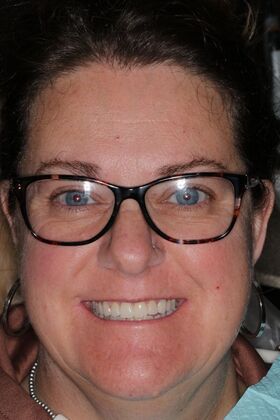 Veneers Case 30 - After