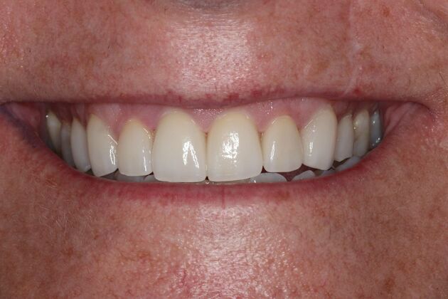 Veneers: Case 30 - After