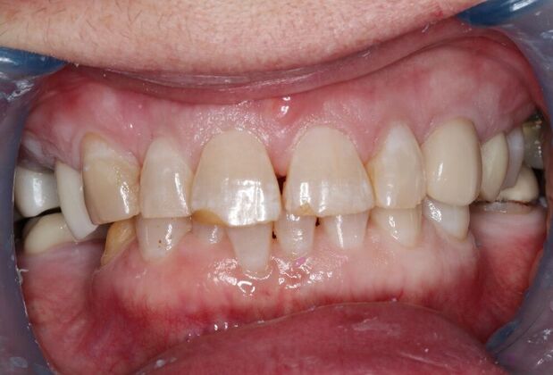 Dental Crowns Case 35 - Before
