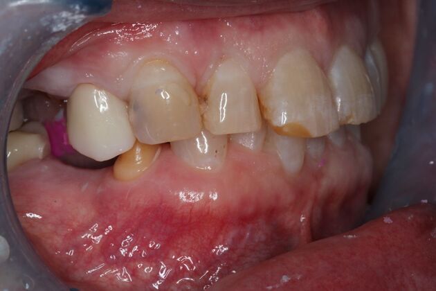 Dental Crowns: Case 35 - Before