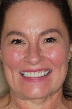 Dental Crowns Case 35 - After